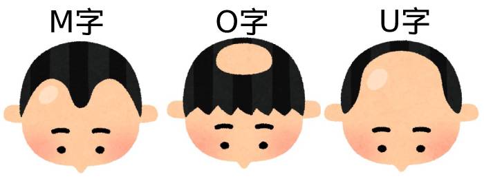 おでこに指4本は普通なのか?知っておきたい薄毛・ハゲ事情
